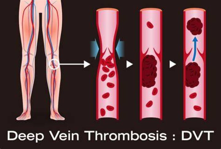 How long can you survive with DVT?