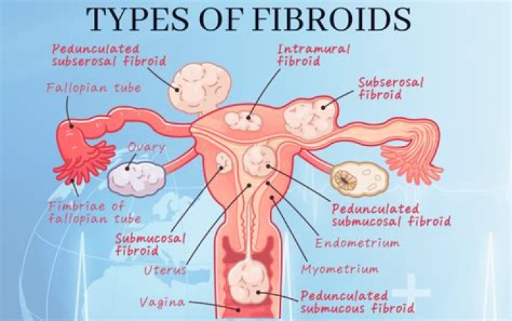 How long do you bleed with fibroids?