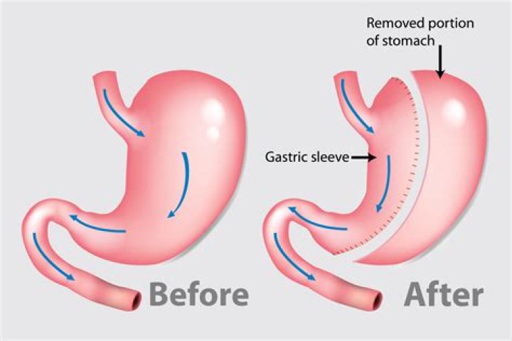 How long do you live after a gastrectomy?
