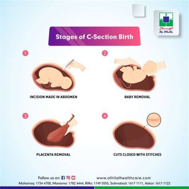 How long does a 2nd C-section take?
