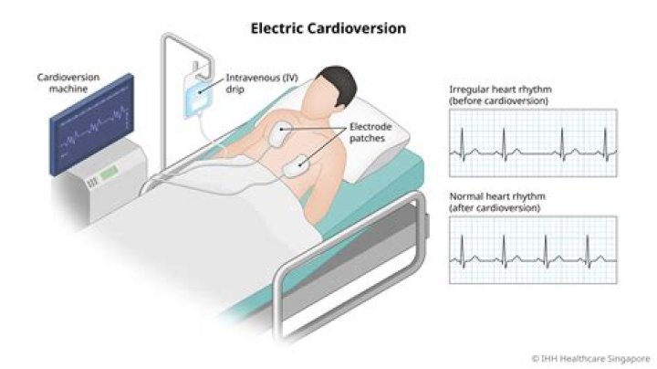 How long does a cardioversion take?
