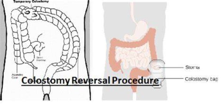 How long does a colostomy reversal surgery take?