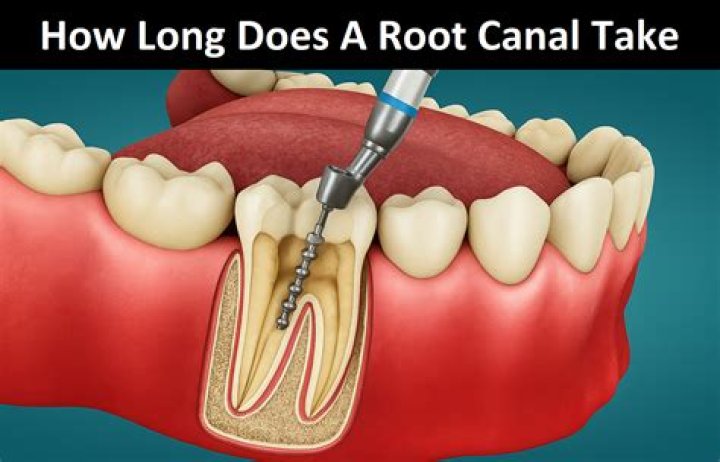 How long does a root Tap last?