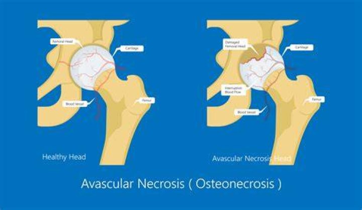 How long does avascular necrosis take to develop?