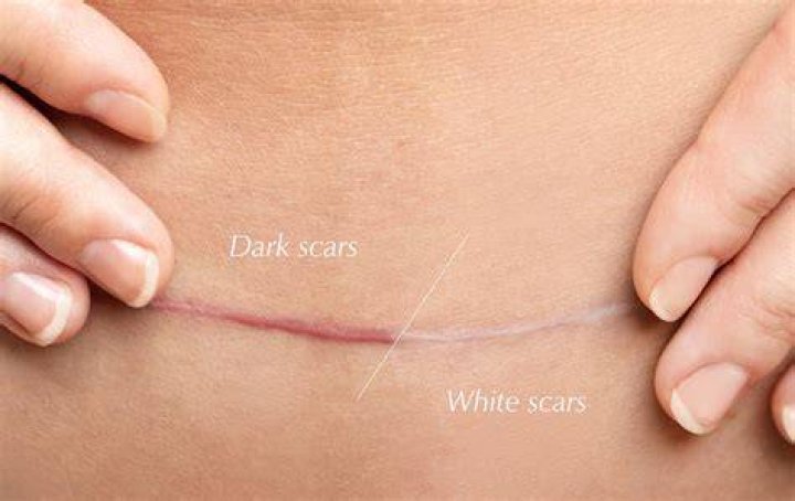 How long does it take for a scar to turn white?