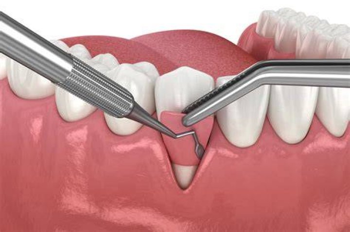 How long does it take for gum tissue to regenerate?