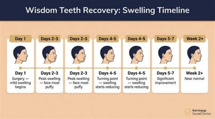 How long does it take for wisdom teeth holes to heal?