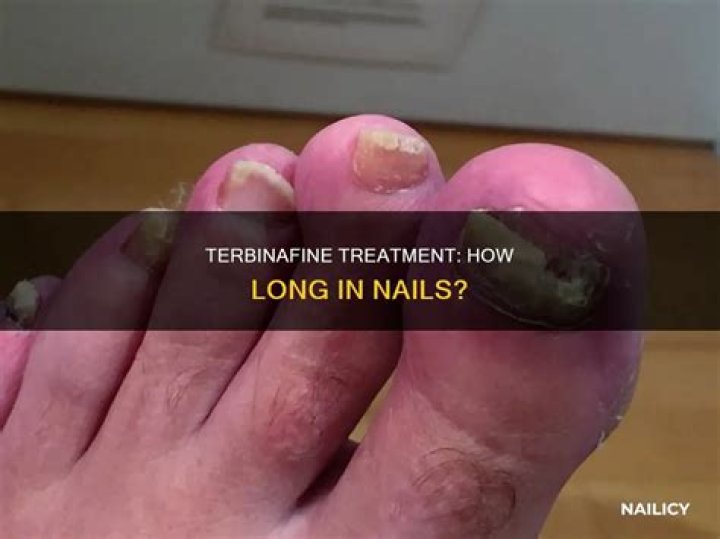 How long does terbinafine take to work on toenails?