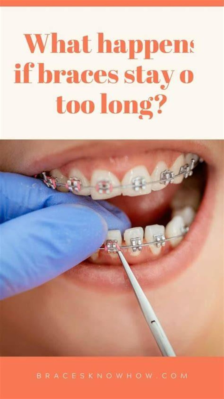 How long is too long for braces?