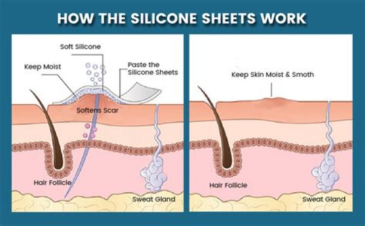 How long should I wear silicone sheets?