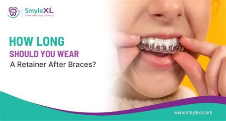 How long should you wear retainers after braces?