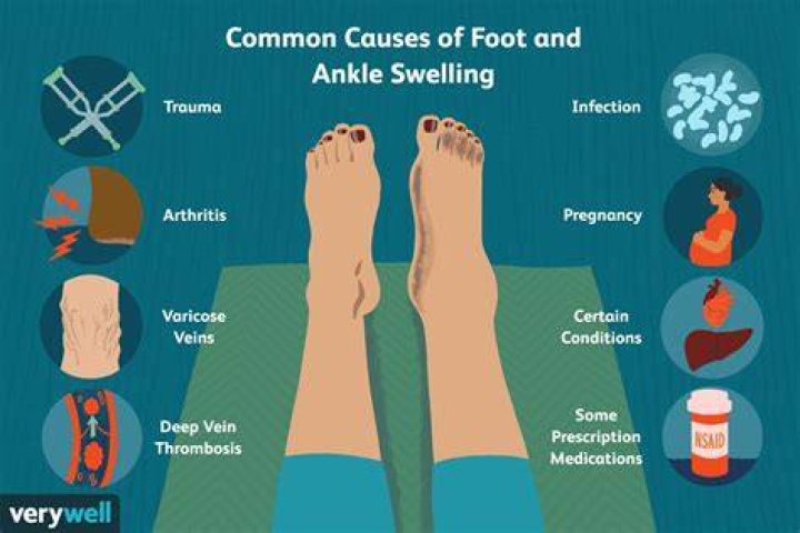 How long will my ankle be swollen after a fracture?