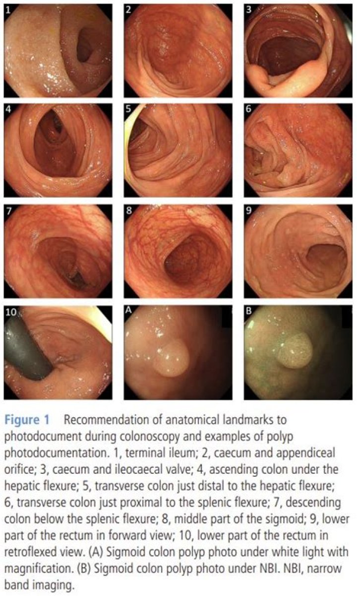 How many biopsies are normal during a colonoscopy?