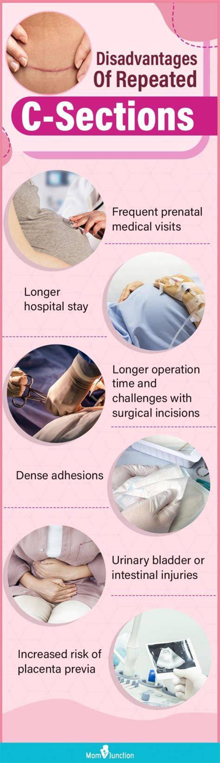 How many C-sections can I have?