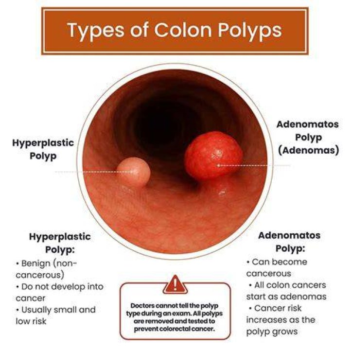 How many polyps is too many colon?