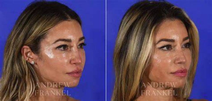 How many rhinoplasties can you have?