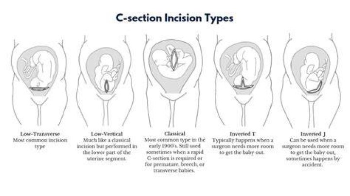 How many types of stitches are used in cesarean delivery?