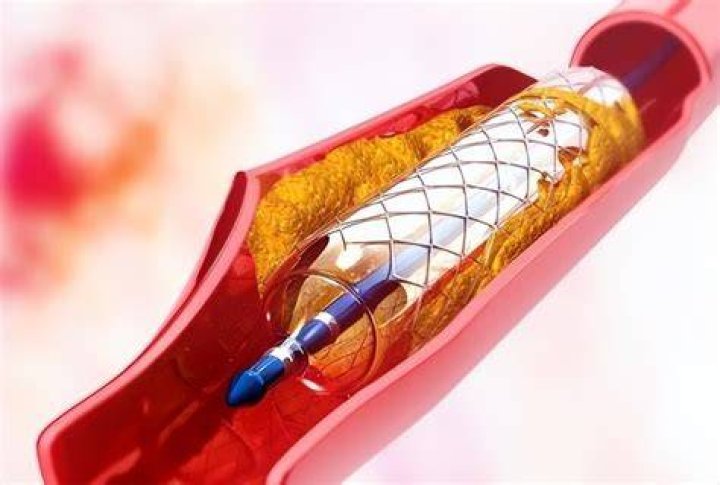 How many years can you live with a stent?