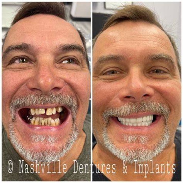 How much does it hurt to get dentures?
