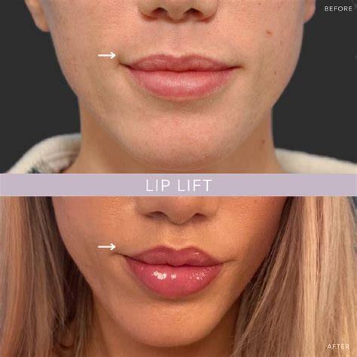 How much skin is removed in lip lift?