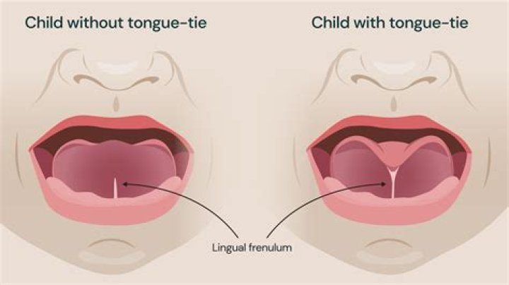 How old do u have to be to get your tongue split?