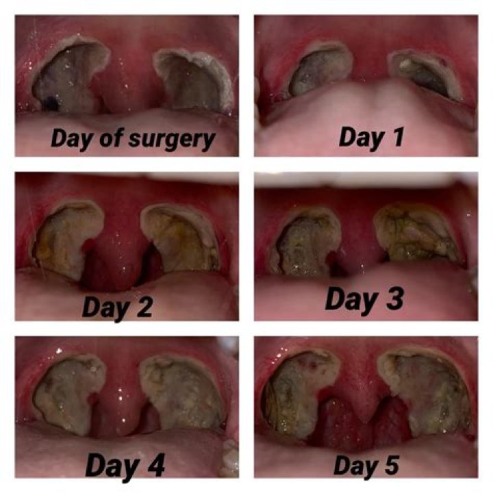 How painful is tonsillectomy recovery in adults?