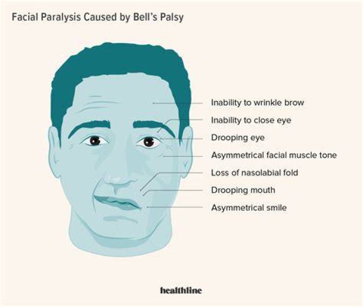 How quickly does Bell's palsy start?