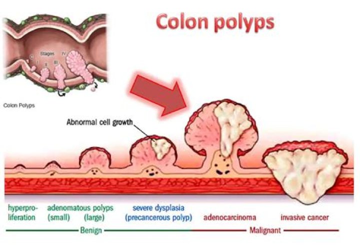 How serious is a precancerous polyp?