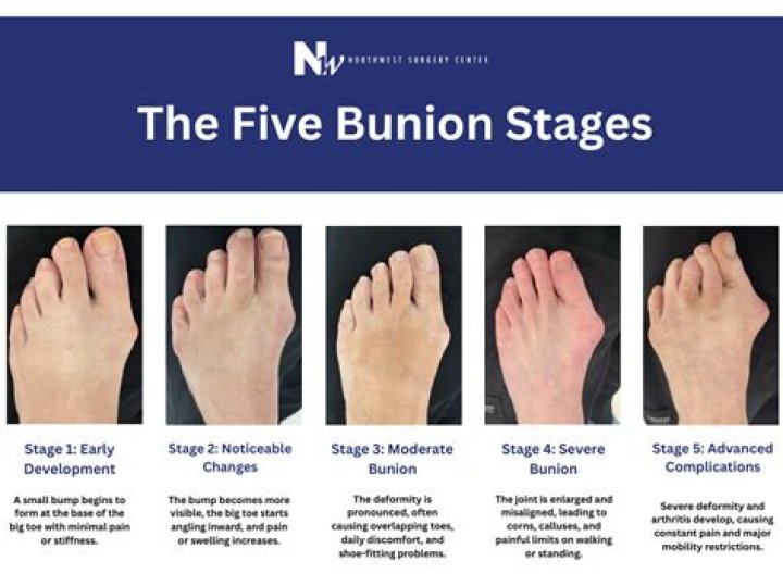 How severe can a bunion get?