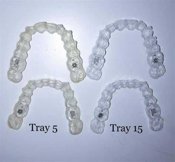 Is 50 trays a lot Invisalign?