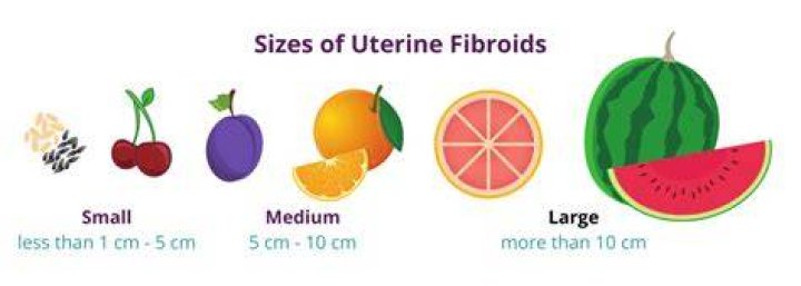 Is a 4 cm fibroid considered large?