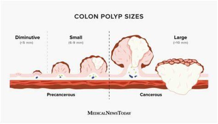Is a 4 cm polyp large?