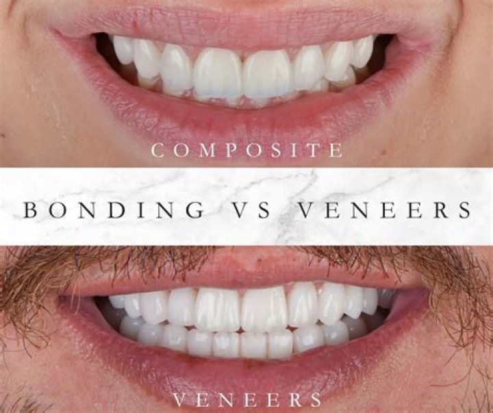 Is a crown better than bonding?