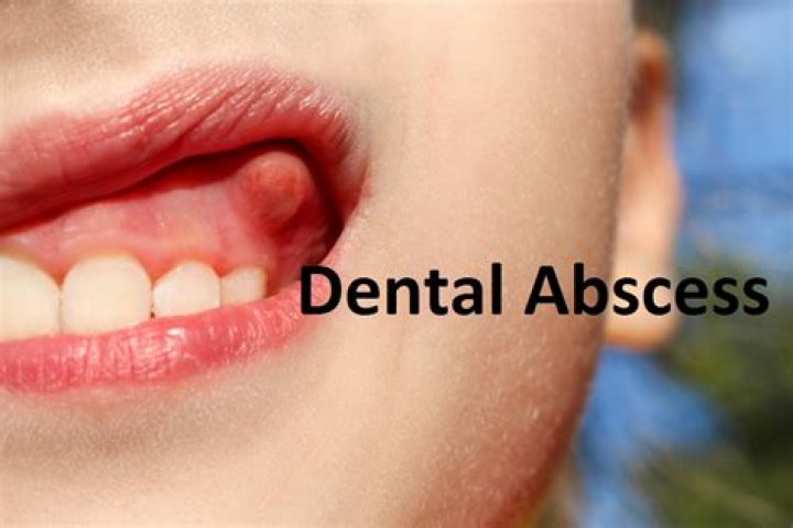 Is a dental abscess an emergency?