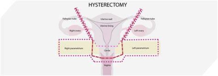 Is a hysterectomy a high risk surgery?