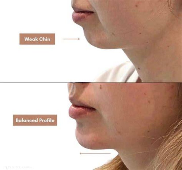 Is a weak chin genetic?