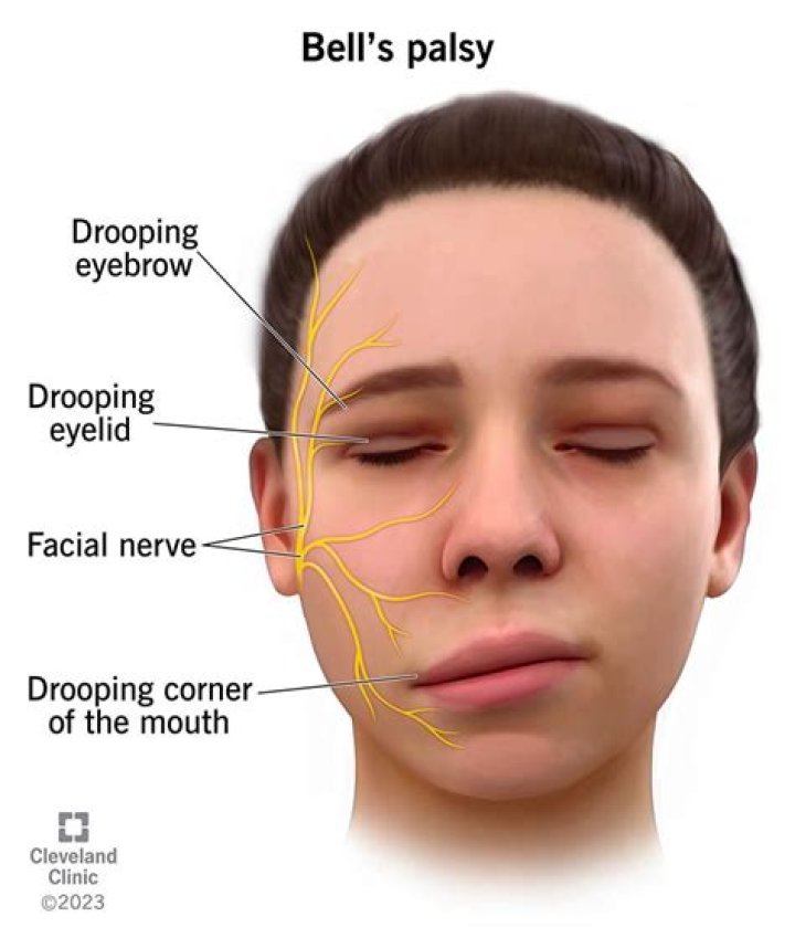 Is Bell's palsy fatal?
