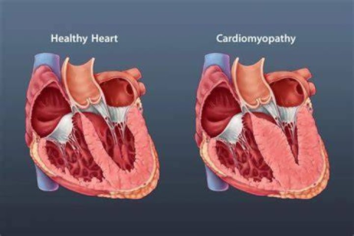 Is cardiomyopathy considered a terminal illness?