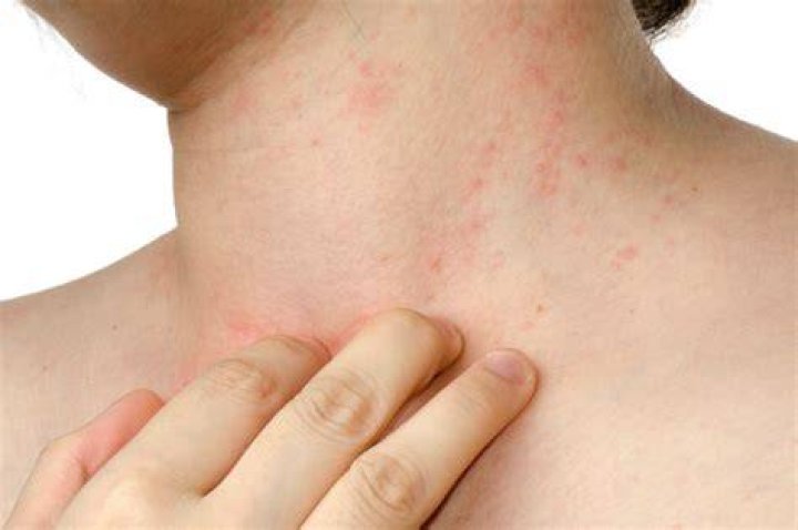 Is dermatitis caused by stress?