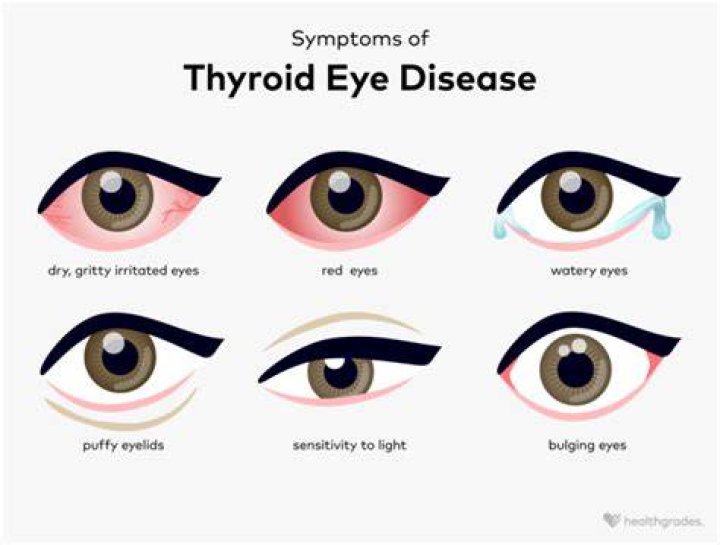 Is dry eyes a symptom of hypothyroidism?