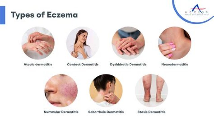 Is Eczema a side effect of diabetes?