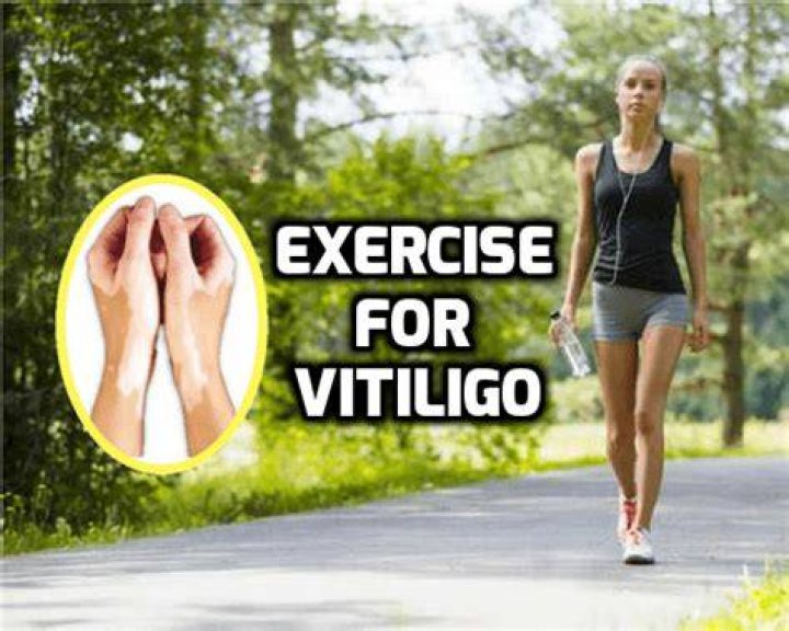 Is exercise good for vitiligo?