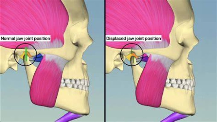 Is Foxy's jaw dislocated?