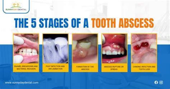 Is hot or cold better for abscess tooth?
