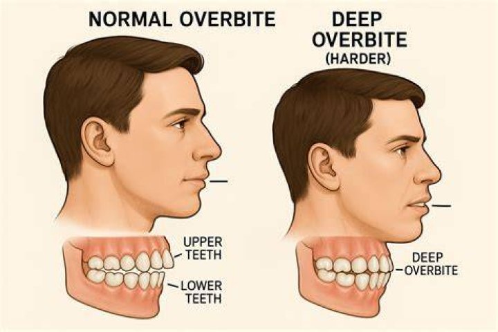 Is it necessary to fix overbite?