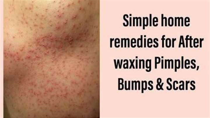Is it normal to get bumps after waxing?