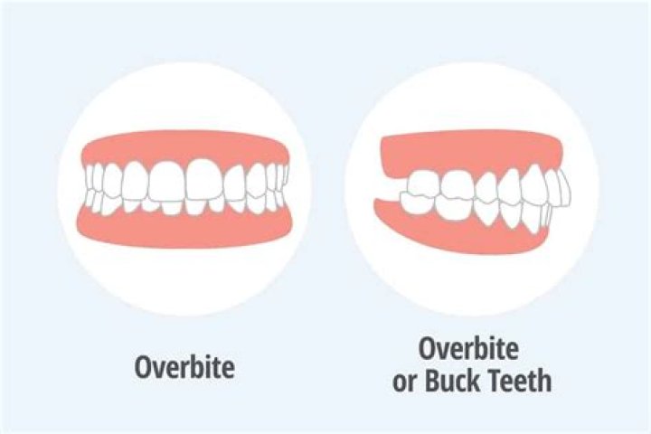 Is it okay to live with an overbite?