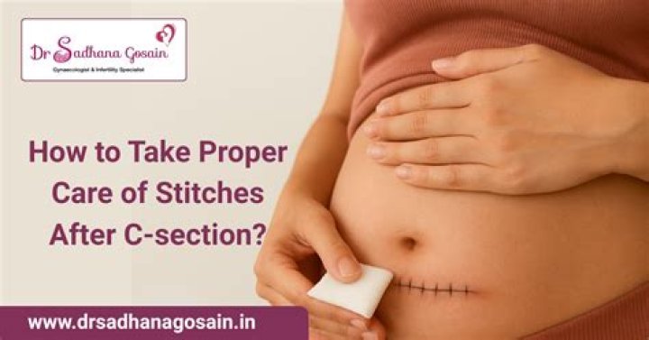 Is it painful to remove C-section stitches?