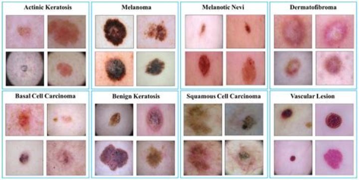 Is Melanoma different from sarcoma?