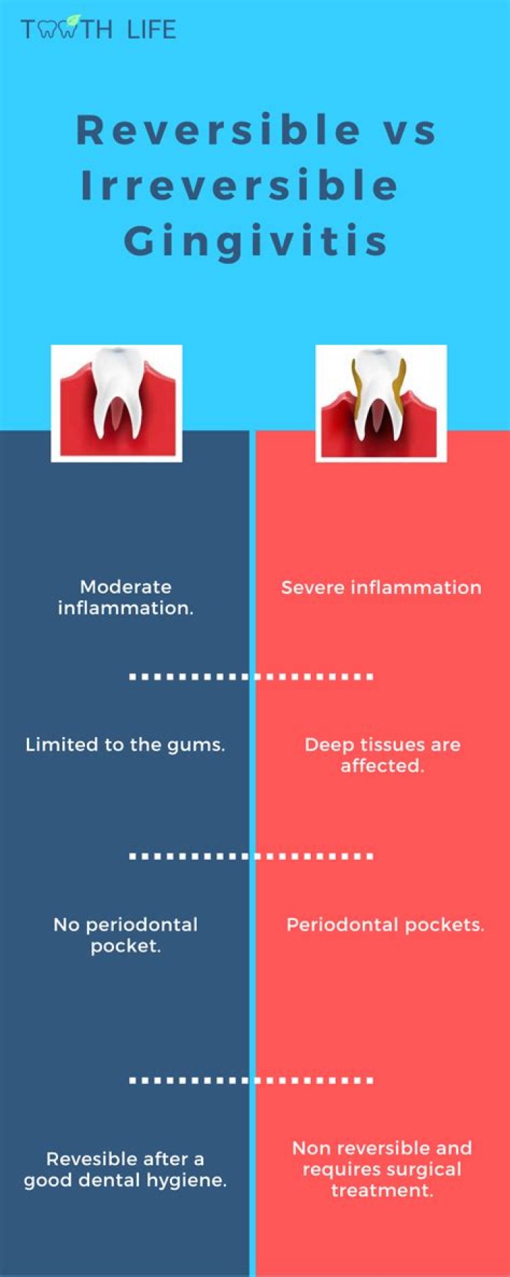 Is periodontitis irreversible?